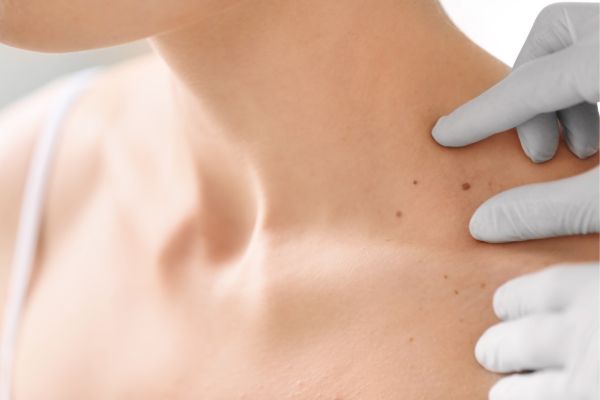 Skin Cancer Screening
